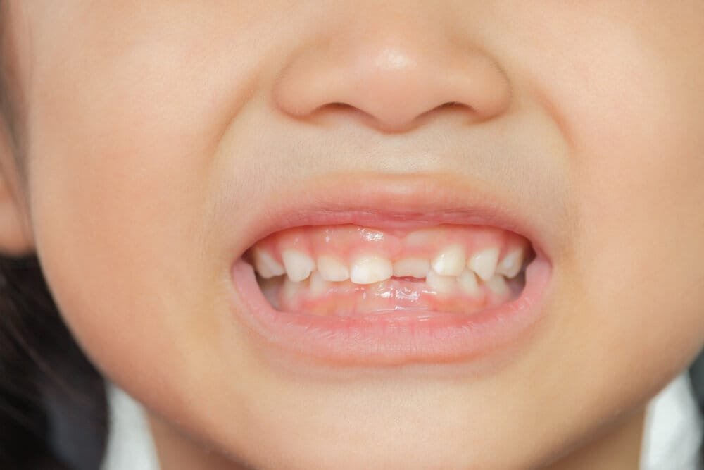 Çocuklarda Diş Sıkma (Bruksizm) Nedir?
