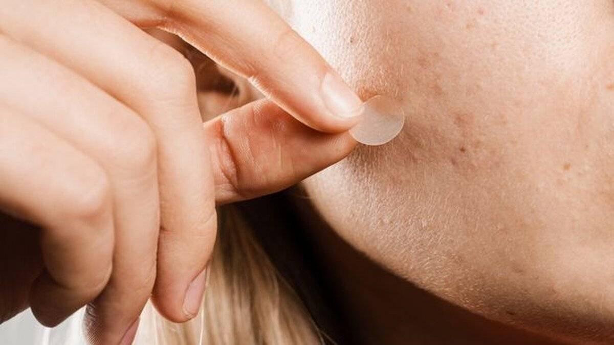 Sivilce Bantları: Gerçekten Etkili Mi?