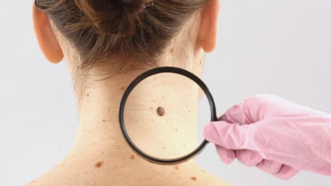 Dermatolog Uyarısı: Gözlenen Değişiklikleri Ciddiye Alın - Kadın Girişim
